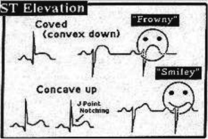 An illustration for medical students showing a quick way to interpret the “ST Elevation” form in an EKG graph using “smiley” and “frowny” faces